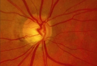 Glaucoma_GALAHAD