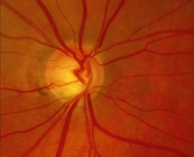 Glaucoma_GALAHAD